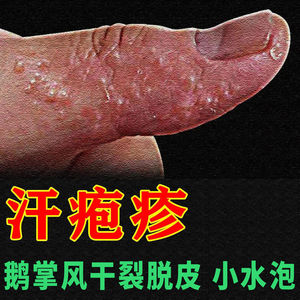 汗疱疹鹅掌风汗状疱疹药膏手癣膏真菌感染起小水泡专用孢疹软膏