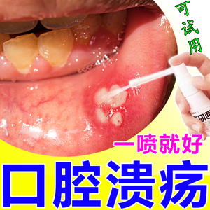 治口腔溃疡的药喷剂