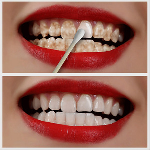 【牙医推荐】速效牙齿美白洁白牙齿神器牙黄提亮去牙渍烟渍洗牙粉