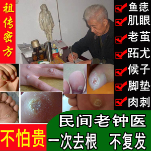 佰草钟医去肉刺猴子血胞肉手足脚眼茧趾跖尤鸡刺专用草本鸡尤眼膏