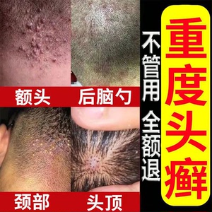 0010人付款淘宝头癣