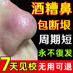 治酒糟鼻红鼻子专用药草莓鼻去红血丝鼻头红肿玫瑰痤疮修复药膏