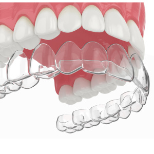 透明隐形牙齿矫正器牙套凸嘴龅牙地包天纠正神器门牙牙缝隙大钢丝