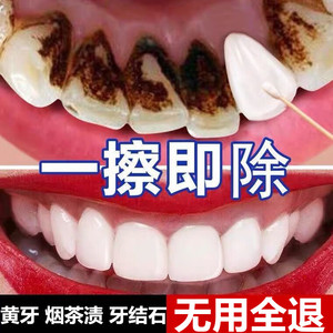 牙齿美白速效黄牙烟渍牙垢牙结石去除器溶解牙石清洁工具洗牙神器