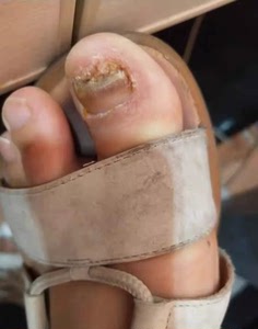 杨四郎神笔灰甲灰指甲专用2ml旗舰店正品