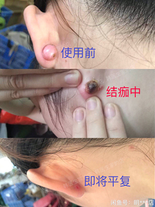 耳朵耳洞疤痕增生肉疙瘩