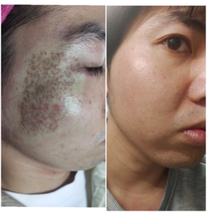 激光淡斑全面部 雀斑/黄褐斑/褐青色痣0人付款59