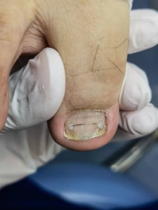 嵌甲钢丝矫正卷甲钢丝矫正钢丝胶水矫正指甲不往肉里长甲沟校正炎