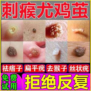 鸡茧安全手部草本脚底猴子肉刺去除膏鱼鳞痣脚疣足底脚垫怎么治療