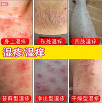 Special treatment for eczema anti-itch fungal infection with cutaneous special treatment with itching scrotum recalcitrant psoriasis psoriasis