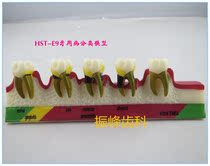 Dental model HST-E9 classification model beautiful appearance Special