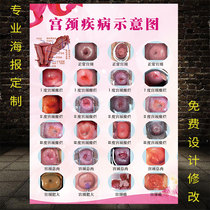 Schematic diagram of cervical diseases gynecologic wall stickers lesion level poster inflammation uterus picture beauty salon wall chart advertisement
