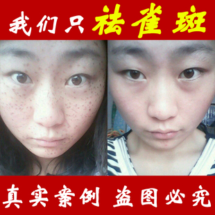 正品中药去雀斑遗传斑产品 美容笔点斑水202雀斑净 特效去斑药水 新品