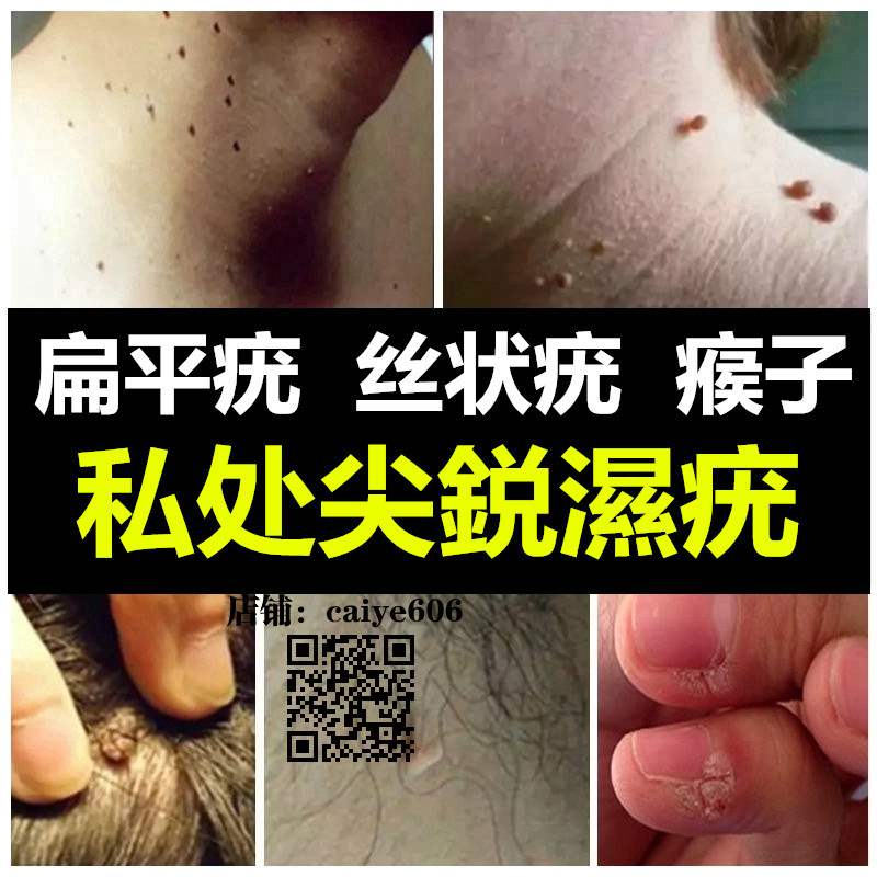 扁平疣去除膏面部祛尖锐疣湿疣丝状疣瘊净日本去疣灵肉刺瘊子跖疣