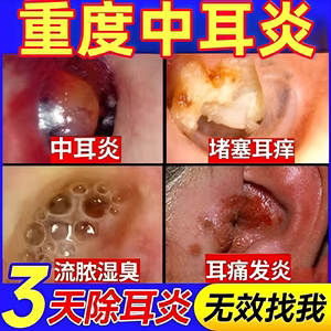 治疗中耳炎专用特效药可除根滴耳液药成人用儿童耳朵流水流脓神器