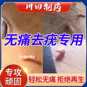 日本去疣膏去脖子上长小肉粒扁平疣寻常疣鸡眼跖疣瘊子一抹灵神器