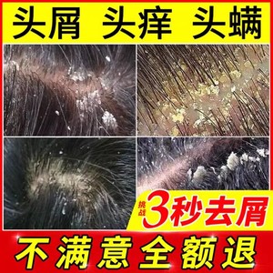 洗发水去屑止痒控油蓬松头皮毛囊清洁除螨露男女专用正品旗舰店