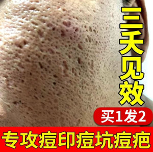 祛痘坑凹洞修复男士去痘印痘坑痘疤膏淡化填充再生凝胶旗舰店正品