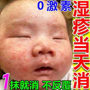 宝宝身体乳干性湿疹霜儿童脸上皮炎止痒去湿疹膏婴儿专用无激素根