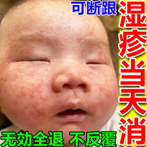 宝宝身体乳干性湿疹霜儿童脸上皮炎止痒去根湿疹膏婴儿专用无激素