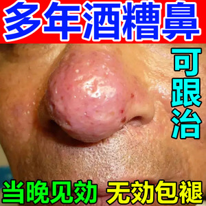 日本治疗酒糟鼻专用药膏去鼻翼两侧泛红粉刺治红鼻子药膏面部痤疮