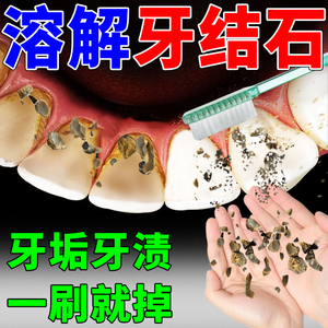 牙结石去除神器洗牙粉去黄去牙垢烟渍溶解清理牙结石黑牙菌斑牙膏