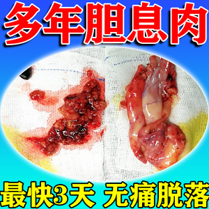 胆囊息肉中药胆结石多发息肉胆囊炎溶石化石排石茶专用特效中药贴