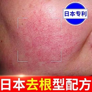 花田美芙舒缓精华霜去红血丝修复敏感肌肤泛红干痒改善过敏红斑。