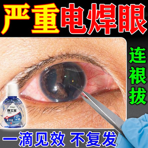 电焊打眼专用眼药水氩弧焊伤眼闪眼电焊工专用滴眼液电焊宝护眼液