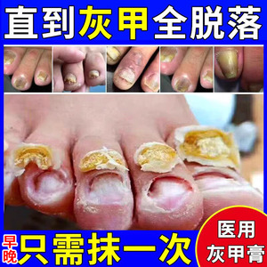 灰指甲治疗用药治灰指甲亮甲真菌感染指甲发黄增厚空甲去甲沟炎