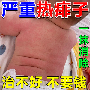 婴儿热痱子药膏去痱子止痒宝宝儿童专用皮肤湿疹止痒去根外用膏