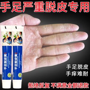 手足脱皮膏严重手脚专用蜕皮药真菌感染治疗手掌手指上起皮干燥掉