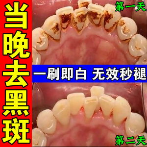 儿童牙齿黑斑去除牙膏去祛牙菌斑黄黑渍黑线牙窝沟黑色素沉淀神器