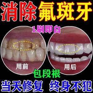 氟斑牙专用牙膏去牙渍牙垢黄牙美白牙斑菌釉质修复牙结石清除神器