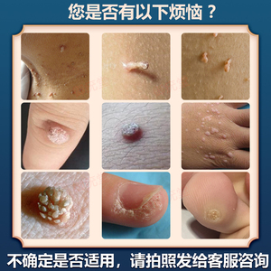 刺猴扁平疣,刺猴跖疣(第13页)_大山谷图库
