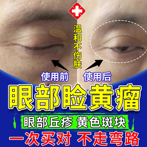 眼脸黄瘤膏去除疣可搭配膏药贴睑黄色瘤祛脂肪粒眼部角斑治汗管QY