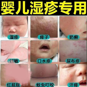 宝宝湿疹霜皮肤专用治疗婴儿湿疹止痒去根抑菌幼儿无激素保湿热疹