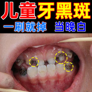 儿童牙菌斑牙膏去牙菌斑黑牙黑斑黑渍污垢清洁祛除神器含氟防蛀牙