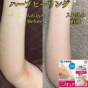 小林制药去鸡皮膏 保湿日本疙瘩毛囊角质全身胳膊软化膏30g