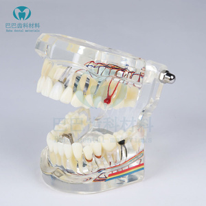 牙科口腔教学 可拆卸种植体修复模型 活动牙种植牙 医患沟通 包邮
