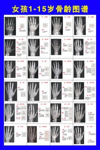 定制男孩女孩骨龄图谱骨密度检测重要性写真图背胶海报多图任选