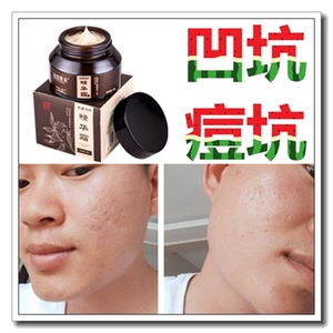 冻干粉祛男士痘印痘坑毛孔粗大淡化疤痕日本面膜去女凹陷修复工具