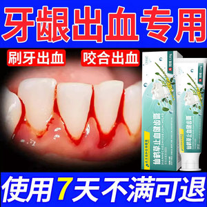 牙龈出血专用牙膏牙周炎去黄去口臭美白肿痛护理修护萎缩消炎HH