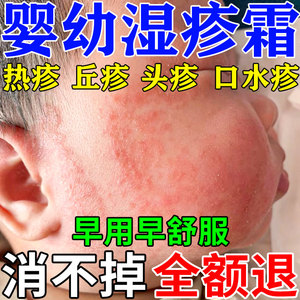 婴宝湿疹婴儿专用紫草膏热疹口水疹儿童去皮肤止痒根保湿霜无激素