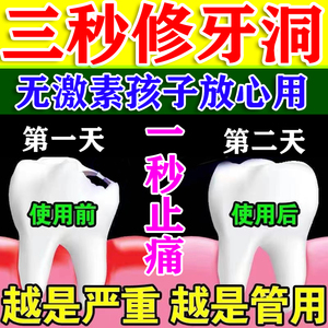 防蛀牙牙洞喷剂烂牙斑龋齿清理牙膏牙疼自己补洞成人儿童防护固齿