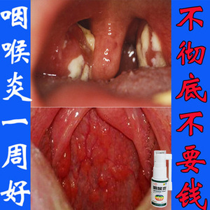 慢严舒柠清喉利咽颗粒喷剂急慢性咽炎咽干咽痒痛扁桃体咽喉炎的药