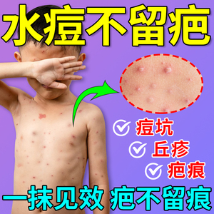 水痘疤痕修复儿童去痘印黑色素沉淀痘坑成人淡化伤疤凸起止痒药膏