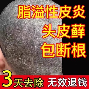 脂溢性皮炎去 根除头皮癣头癣头皮屑癣头部面部外用软膏专用药膏