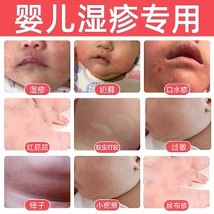 宝宝湿疹霜湿疹婴儿专用保湿霜身体乳干性皮肤去湿疹修护润肤面霜