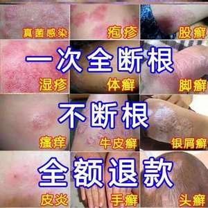 香港代购蚊虫叮咬日本湿疹反复发作怎么办澳洲膏防药膏止痒水